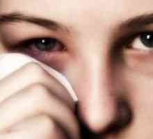 Conjunctivita alergica: tratament, simptome, cauze, simptome