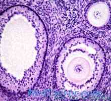 Arrhenoma histologie ovarian, anatomie patologică