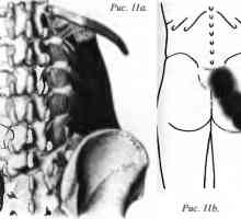 Durerile de spate cauzate Quadratus lumborum