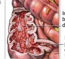 Boala intestinului subtire Crohns
