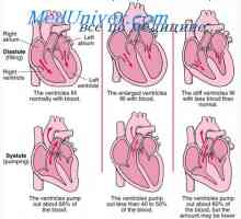 Debitul cardiac, după un atac de cord. insuficiență cardiacă compensată