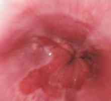 Boala de reflux gastro-esofagian: tratament, simptome, cauze, simptome