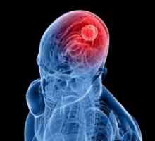 Hematom epidural al creierului: simptome, tratament, consecințele