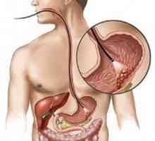 Limfomul a stomacului și de colon: tratament Pronoza, semne, simptome, cauze