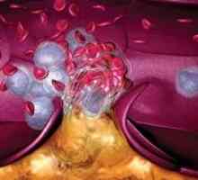 Tulburări ereditare de interior de trombocite