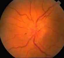 Sistem optic nevrite: simptome, tratament, cauze, diagnostic, prognostic