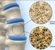 Osteoporoza Bone: tratament, simptome, cauze, simptome, prevenire, diagnostic