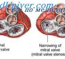 La stânga insuficiență ventriculară. Hemodinamica in stenoza mitrala si insuficienta mitrala