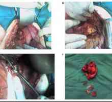 Înfrângerea helminți pancreasului: echinococoza