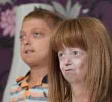 Copii Progeria: simptome, tratament, cauze