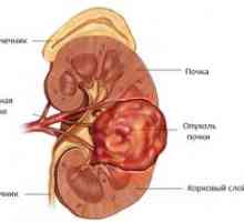 Carcinomul pelvisului renal si ureter: semne, simptome, cauze, tratament