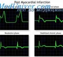 Recuperarea de infarct miocardic. Restul după un atac de cord