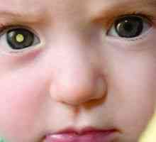 Retinoblastomul la copii: simptome, tratament, cauze, simptome
