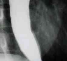 Rezultatele examinării cu raze X a esofagului și stomacului