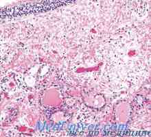 Sifilisul morfologia tiroidei, anatomie patologică