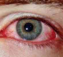 Sindromul de ochi roșii: Tratamentul
