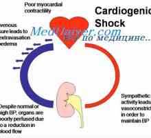 Șoc cardiogen. Fiziologia tratamentul șocului cardiogen