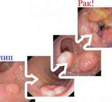Tipuri de polipi în stomac