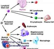 Transplantul de celule stem si limfom Hodgkin (boala Hodgkin)