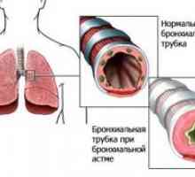 Malformații congenitale ale bronhiilor