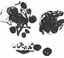 Boli ale sistemului hematopoietic. limfom Hodgkin (boala Hodgkin)