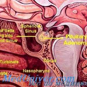 Diagnosticul, diferențierea, tratamentul și prognosticul chromophobe adenom pituitar