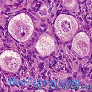 Seminom Disgerminoma sau ovare. Lipoidnokletochnye virilizare tumori ovariene