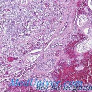 Gormonalnoaktivnye tumori testiculare leydigomy