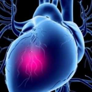 Șoc cardiogen: tratament, simptome, cauze, simptome