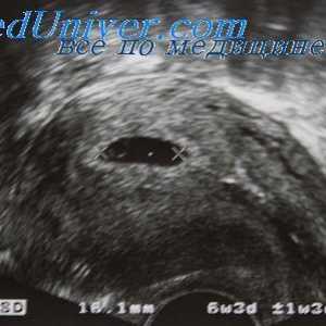 Este necesar să se efectueze cu ultrasunete fiecare gravidă. În măsura în care este screening-ul cu…