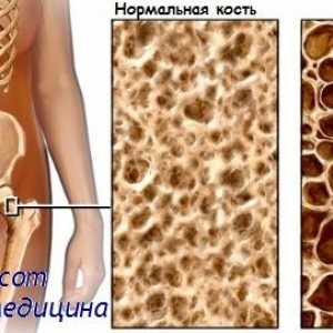 Osteomalacia. Osteoporoza si caracterizarea osteoporozei
