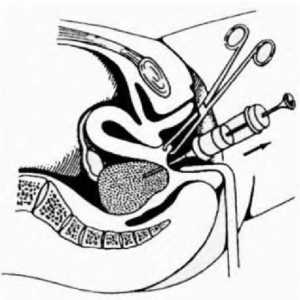 Puncția cavității abdominale prin fornixul vaginal posterior (kuldotsentez)