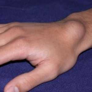 Sarcom de țesut pe zona de mână și încheietura mâinii: cauze, tratament