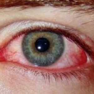 Sindromul de ochi roșii: Tratamentul