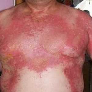 Sindromul stafilococică pielii opărite: tratament, cauze, simptome, semne