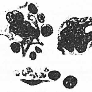 Boli ale sistemului hematopoietic. limfom Hodgkin (boala Hodgkin)