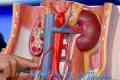 Insuficiență renală în stadiu terminal la copii. peritoneoclysis