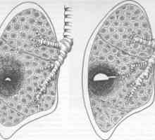 Lung abcesul: simptome, tratament, diagnostic, complicatii, cauze, simptome