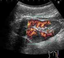 Abcesele pancreasului