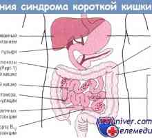 Efectul sindromului de intestin scurt (CCM) asupra tractului gastro-intestinal