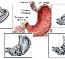 Adenocarcinomul (cancer), stomac