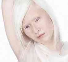 Albinism la om, ochi