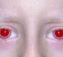 Albinism la oameni: simptome, cauze, simptome, tratament