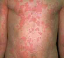Alergii cu limbrici
