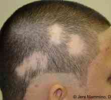 Alopecia areata: tratament