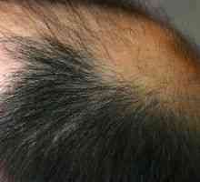 Alopecia parului: tratament, cauze, simptome, semne