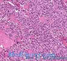 Amiloid de cancer tiroidian. cancer schiros a glandei tiroide