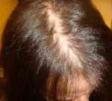 Alopecia androgenetica la femei, la barbati: simptome, tratament