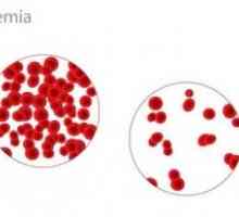Anemia si pierderea de sange ascunse de la nivelul tractului gastro-intestinal