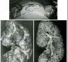 Anomalii de dezvoltare și starea de rinichi. anomalii renale chistice